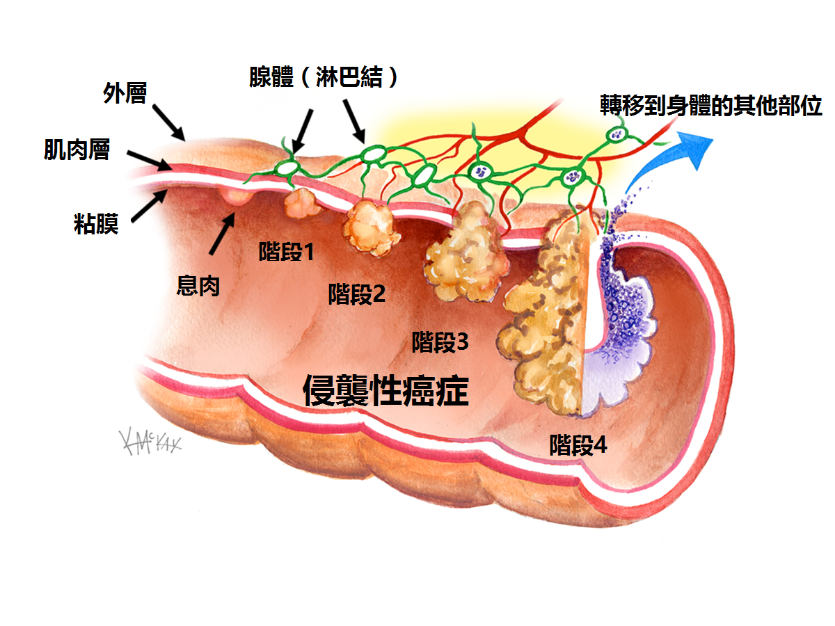 鼻息肉是如何形成的？ - 知乎